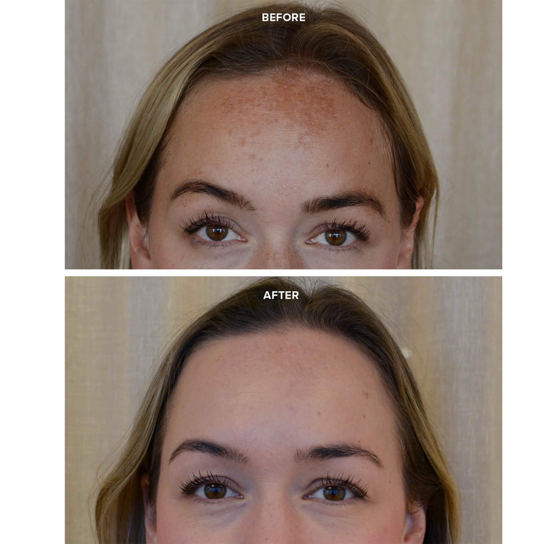 PRIORI Unveiled Red Light LED Face Mask Before and After for treatment of dark spots on forehead and face.