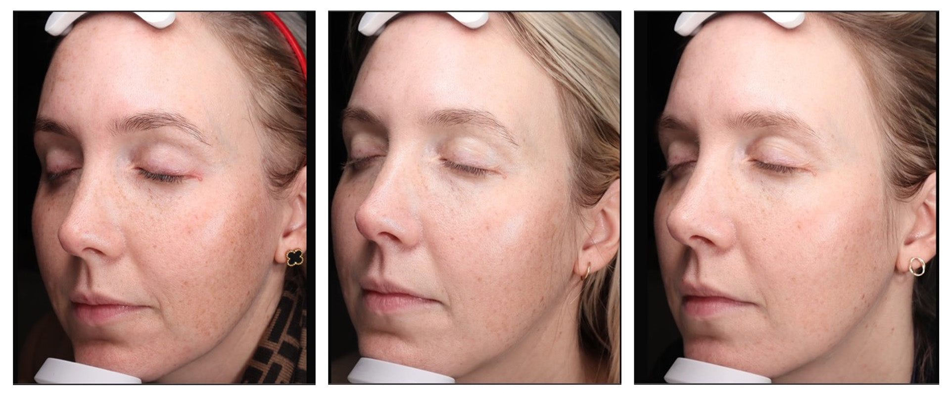 PRIORI Skincare Red Light LED Face Mask Treatment Before and After 12 weeks removes dark spots
